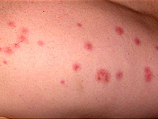Bug Bites in Bed: How to Identify and Stop the Problem