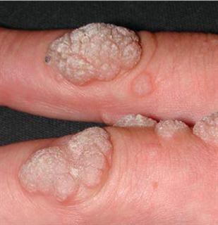 Genital Human Papilloma Virüs(HPV) Nedir?