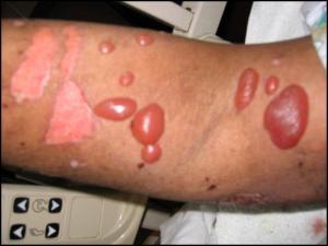 What Is a Staph Infection? Symptoms, Pictures - OnHealth