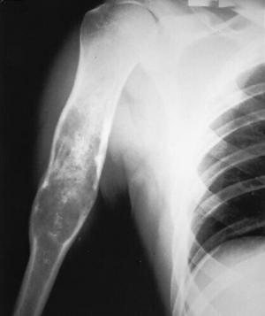8399_chondrosarcoma
