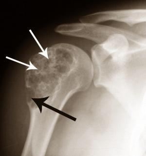 8399_chondrosarcoma-pictures-2
