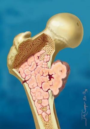 8399_chondrosarcoma_(1)