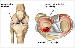8563_meniskus