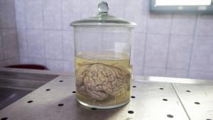 Herpes Vir&uuml;sleri Alzheimer Hastalığına Neden Olabilir Mi?