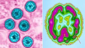 Herpes Vir&uuml;sleri Alzheimer Hastalığına Neden Olabilir Mi?