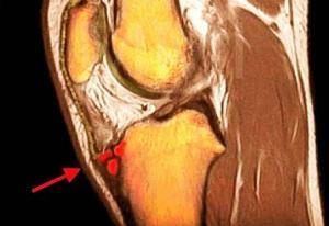 Ergenlerde G&ouml;r&uuml;len Osgood - Schlatter Hastalığı Nedir?