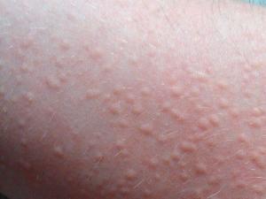 Solar Urticaria Hastalığı
