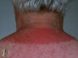 Solar Urticaria Hastalığı