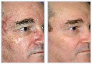 Kimyasal Peeling Nedir?