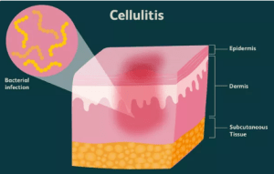Cildin Derin Katmanlarının Bakteriyel Bir Enfeksiyonu: Selülitis