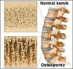 Osteoporoz(Kemik Erimesi) Nedir? Belirtileri ve Tedavi Yolları Nelerdir?