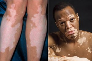Vitiligo Hastalığı Nedir? Tedavisi Mümkün Müdür?