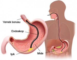 Endoskopi Nedir? Nasıl Uygulanır? Çeşitleri Nelerdir?