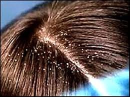 Saçlarda Kepeklenmenin Nedenleri ve Tedavi Yöntemleri