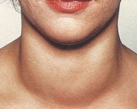 Guatr Hastalığı Nedir? Tedavisi Nasıl Yapılır?