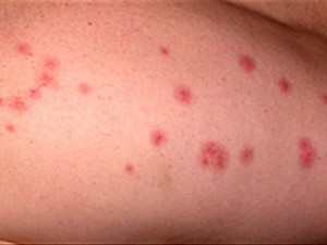 Sıtma Hastalığı(Malaria) Nedir? Belirtileri ve Tedavi Yöntemleri Nelerdir?