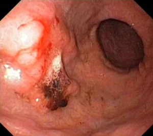 Gastrit Nedir? Belirtileri Nelerdir? Nasıl Tedavi Edilir?