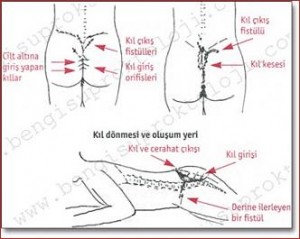 Kıl Dönmesi Nedir? Sebepleri, Belirtileri ve Tedavi Yöntemleri Nelerdir?