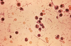 Basilli Dizanteri Nedir? Belirtileri Nelerdir? Nasıl Tedavi Edilir?