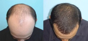 Fue Saç Ekim Yöntemi Nedir? Nasıl Uygulanır?