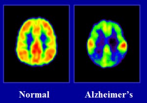 Alzheimer Nedir? Oluşma Nedeni ve Belirtileri Nelerdir?