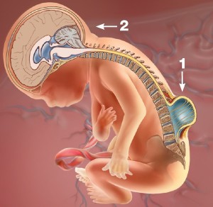 Spina Bifida Hastalılığı ve Tedavi Yöntemleri