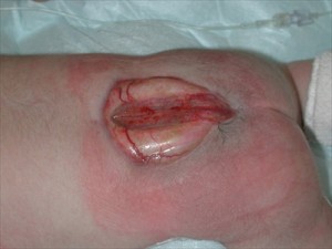 Spina Bifida Hastalılığı ve Tedavi Yöntemleri