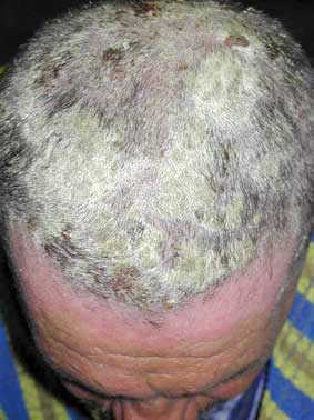 Sedef Hastalığı(Psoriasis) Nedir? Tedavi Yöntemleri Nelerdir?