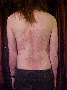 Sedef Hastalığı(Psoriasis) Nedir? Tedavi Yöntemleri Nelerdir?