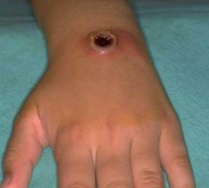 Şarbon Hastalığı(Anthrax) Nedir?