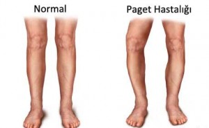 Paget Hastalığı (kemikte) Nedir?