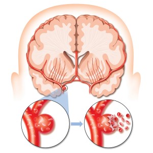 İnme Nedir? Sebepleri Nelerdir?