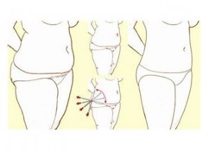 Liposuction(Yağ Alma Yöntemi) Nedir? Nasıl Yapılır?
