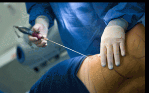 Liposuction(Yağ Alma Yöntemi) Nedir? Nasıl Yapılır?