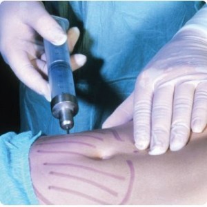 Liposuction(Yağ Alma Yöntemi) Nedir? Nasıl Yapılır?