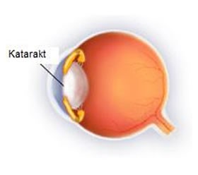 Göz Hastalıkları ve Tedavi Yöntemleri
