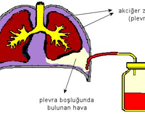 Akciğer Sönmesi Nedir?