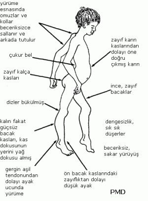 Musküler Distrofi Nedir?