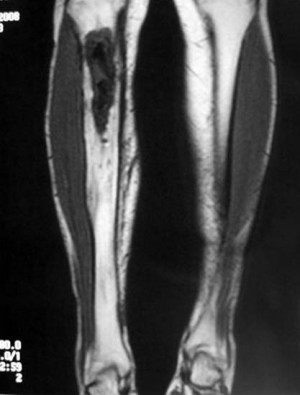 Osteomiyelit (Kemik İliği İltihabı) Nedir?