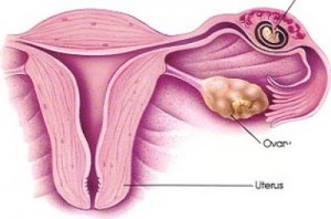 Ektopik Gebelik(Dış Gebelik) Nedir? Belirtileri ve Tedavi Yöntemleri Nelerdir?