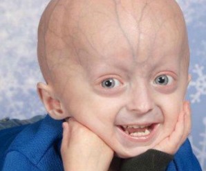 Progeria (Yaşlılık Hastalığı) Nedir? Tedavisi Mümkün Müdür?