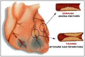 Koroner Arter Hastalığı Nedir? Koroner Arter Baypas Ameliyatı Neden Yapılır?