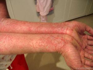 eczema-treatment-1