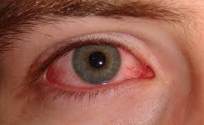 4653_pink_eye