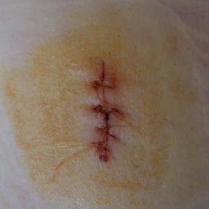 4914_wound_sewed