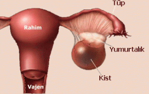 5338_yumurtalik-kanseri