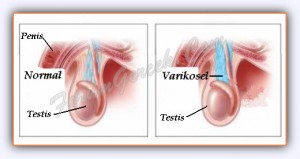 5365_varikosel