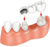 Diş Protezi Nedir? Türleri Nelerdir?
