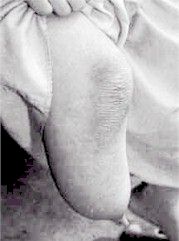 5681_birthmark10