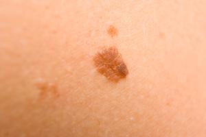 5681_why-do-people-have-birthmarks_80402118.s300x300